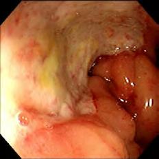 round/oval ulcers