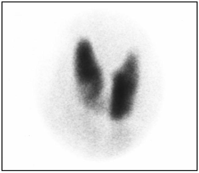 - 김혜숙외 9 인 : 그레이브스병과갈색세포종이병발한 1 예 - A B C Fig. 2. A.Thyroid scan (Tc-99m). B, C. Thyroid ultrasonogram (B. Right, C. Left). Diffuse goitor.