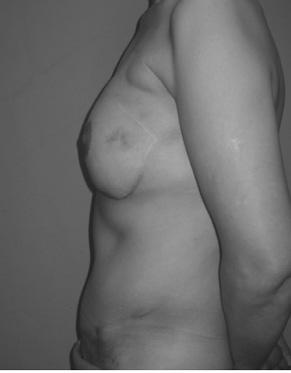 Breast reconstruction on her left