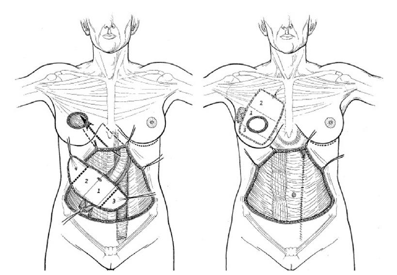 Recent Knowledge of Breast Reconstruction Harvest and rotation of
