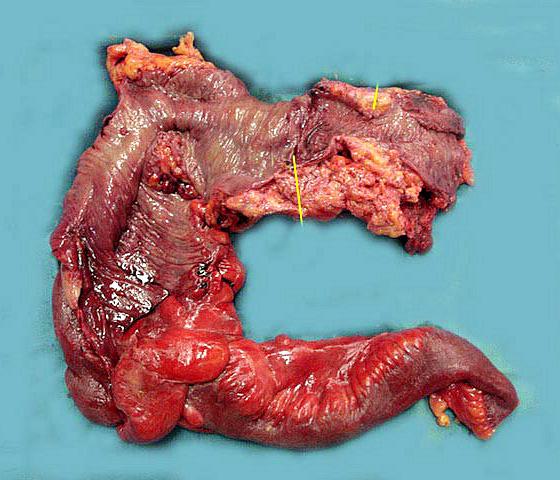 Gross finding of resected specimen revealed severe narrowing of the transverse colon with marked thickening, hardening of the intestinal wall