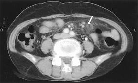 - 대한내과학회지 : 제 71 권부록 3 호 2006 - A B Figure 3. (A) Contrast enhanced CT scan in case 2 shows the fat infiltration of the mesentery in the left abdomen.