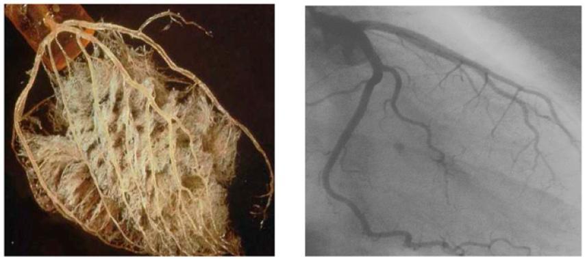 Absolute Perfusion Measurement Need for Quantification of Absolute Myocardial Perfusion Balanced ischemia General