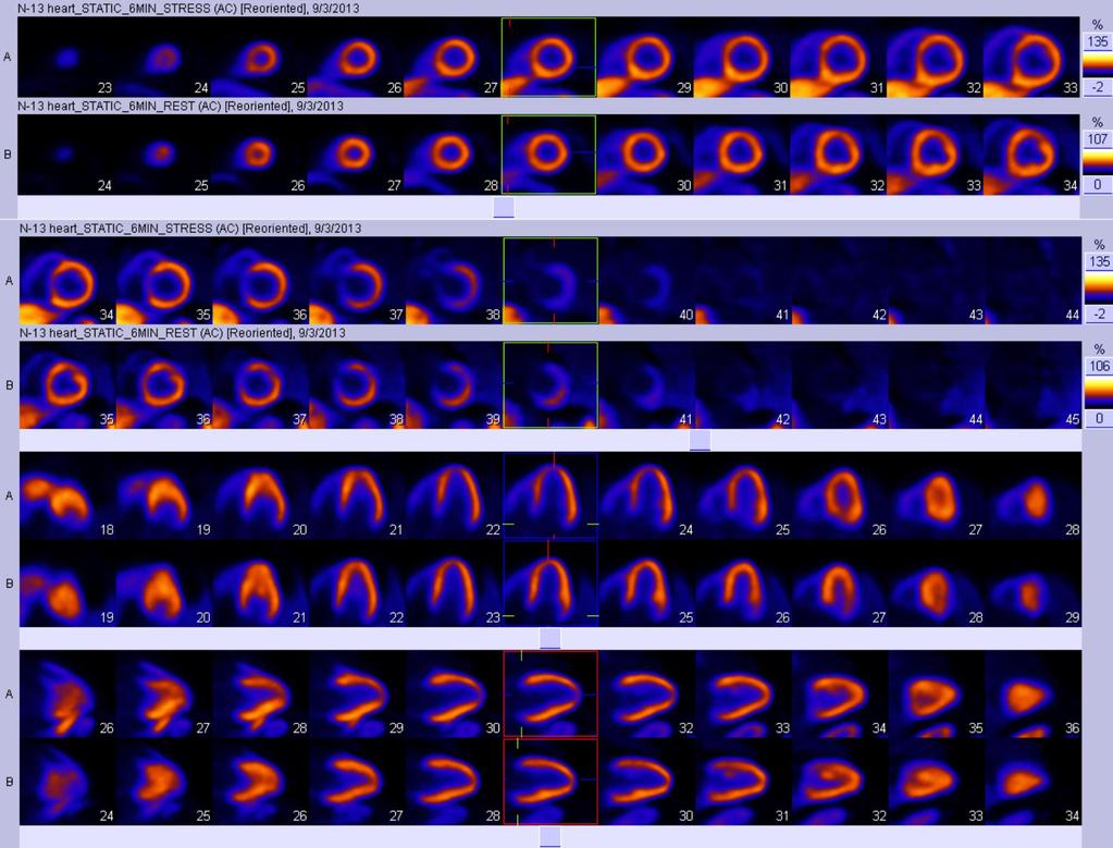 M/61. Underlying DM, CRF without symptom Screening CT CAG: plad 50% CAG: LM and LAD: