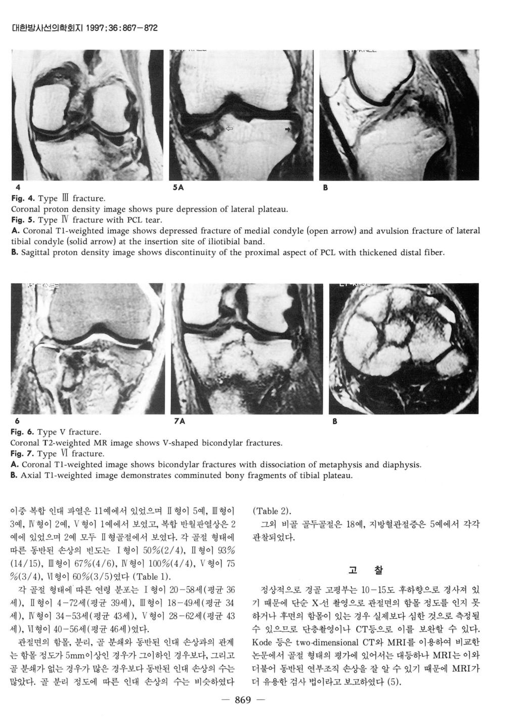 [H 한빙시선의학회 XI1997:36:867-872 4 SA B Fig. 4. Type m fracture. Coronal proton density image shows pure depression of lateral plateau. Fig. S. Type N fracture with PCL tear. A.