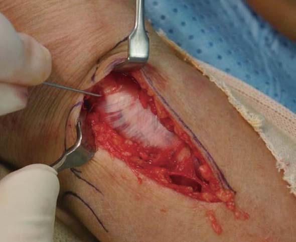 Needle tip indicated the extensor policis longus. (C) Optional retinacular incision method.