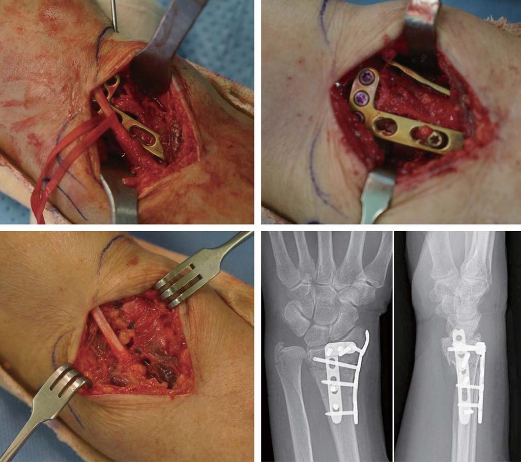 J Korean Soc Surg Hand Vol. 20, No. 2, June 2015 Fig. 4. Dorsal plating technique. (A) Applied appropriate dorsal plate after fracture reduction and temporary fixation. (B) Fixation plate with 2.