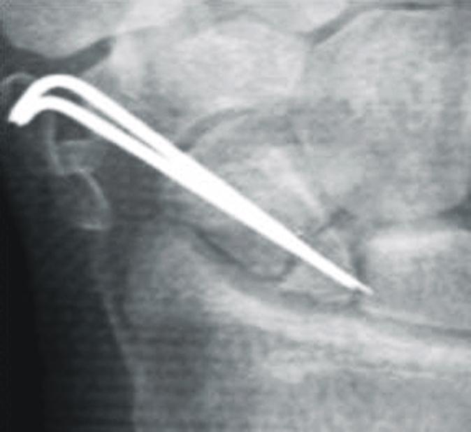(B) Immediate postoperative radiography after a pedicled vascularized bone graft from the distal radius and two K-wire fixations. (C) Follow-up radiography at 30 months shows complete unge.