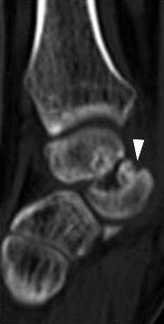 (E, F) Immediate postoperative images (volar approach, Headless screw, K-wire and
