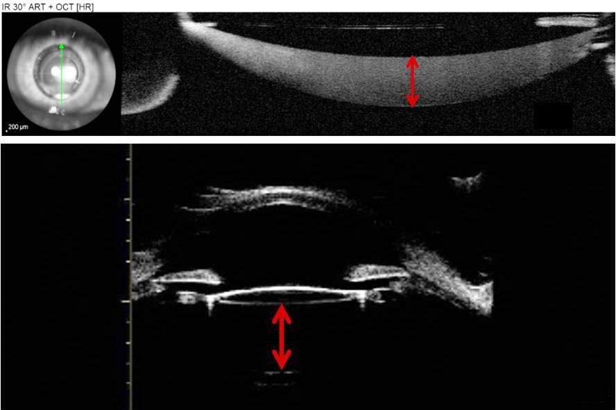 - 안민원외 : 지연낭폐쇄증후군 1 예 - A B Figure 2. Anterior optical coherence tomography and ultrasound biomicroscopy.