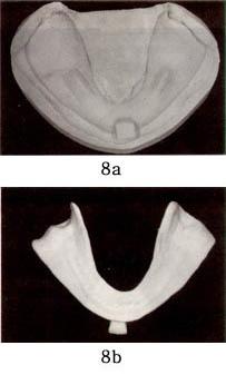 개인용 tray의경계는 sulcus쪽변연부위에서는점막이 sulcus쪽으로 turn out 하기시작하는부위인 tissue reflection point를따라설정한다 ( 그림4)(2).