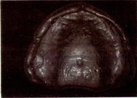 상악에서는입을한번크게벌려 tuberosity부위의 sulcus에서 coronoid process의전방운동을인기하는정도로기능운동을인기한다.
