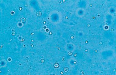 반면무균성농뇨 (sterile pyuria) 에서는부분치료된요로감염일수도있지만질염일수도있고발열, 사구체신염, 사이질신염, 결핵균및혐기성세균에의한감염일수도있으므로감별하여야한다. 호산구는정상소변에서는거의관찰되지않으며소변백혈구의 1% 이상이호산구이면알레르기성사이질신염이거나호산구방광염을의심할수있다.