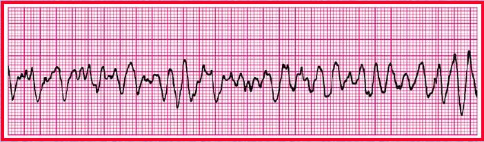 심장의전기적이상신호로인한심장의예상치않은멈춤및떨림현상