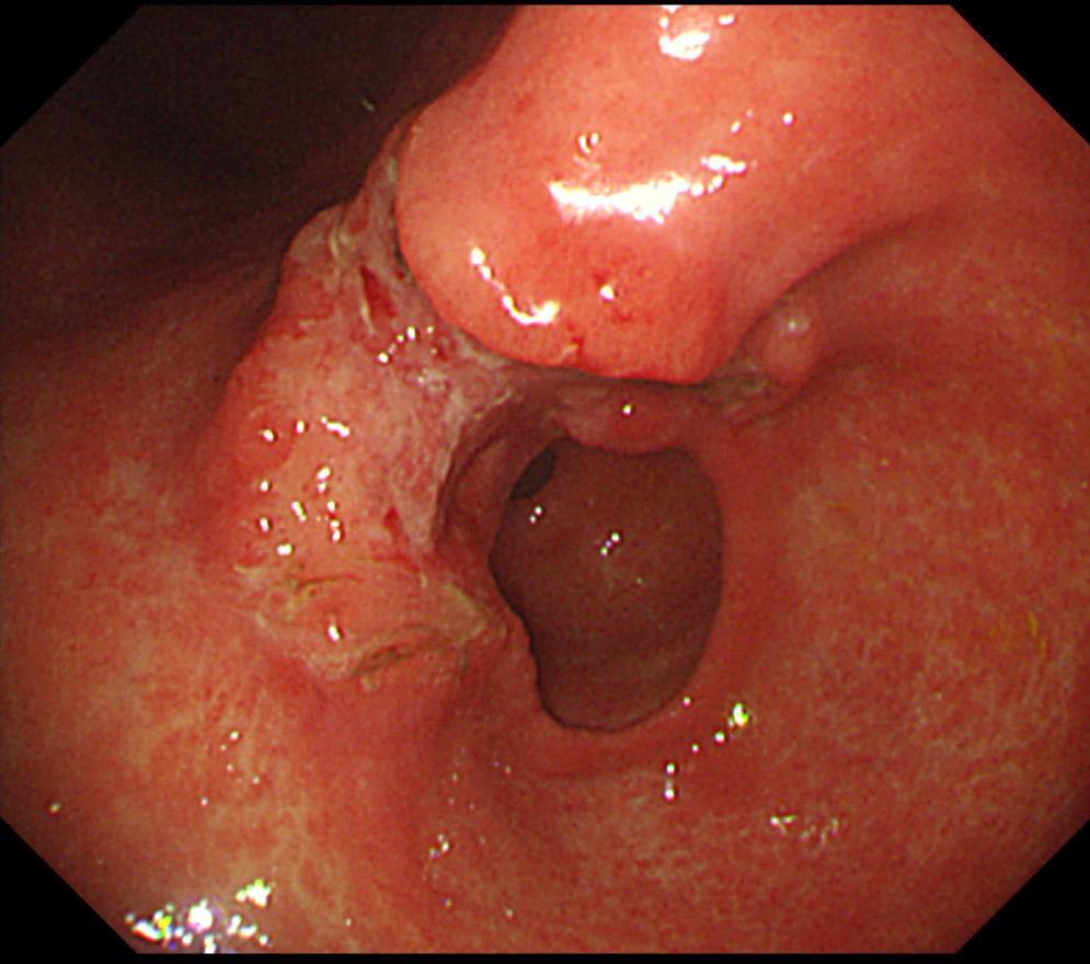 SMC style: example Advanced gastric carcinoma - Gross type : Borrmann type 3 - Histologic type: tubular adenocarcinoma (M/D) - Size : 4.