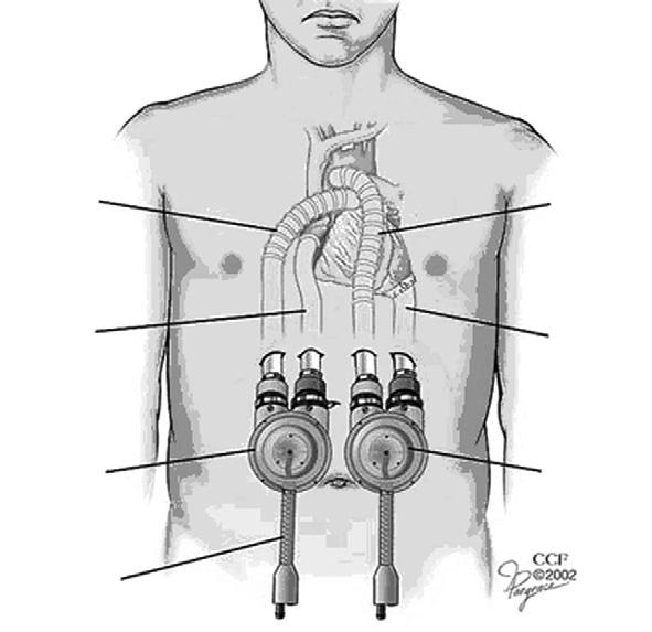 Treatment of Medically Intractable End Stage Heart Failure Outflow conduit Outflow conduit Inflow conduit