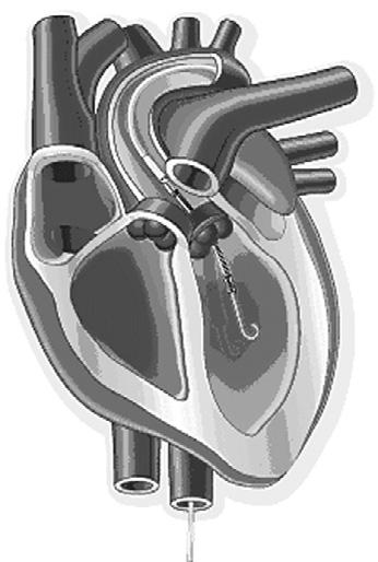 sided pump A Pneumatic drive line B External battery pack Skin entry site Aorta Left ventricle To aorta