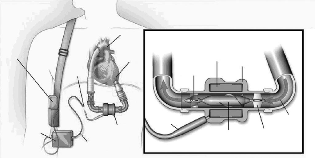 Percutaneous lead Percutaneous lead Rotor Blood flow Inlet stator and blood flow straightener C Figure 3.