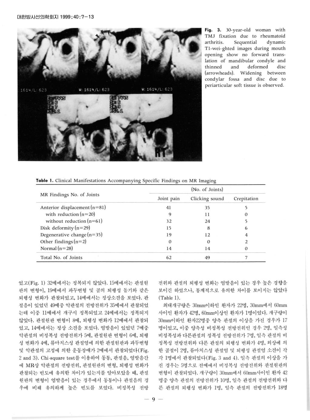 낀대한방사선의학회지 1999 ; 40: 7-13 Fig. 3. 30-year-old woman with TMJ fixation due to rheumatoid arthritis.