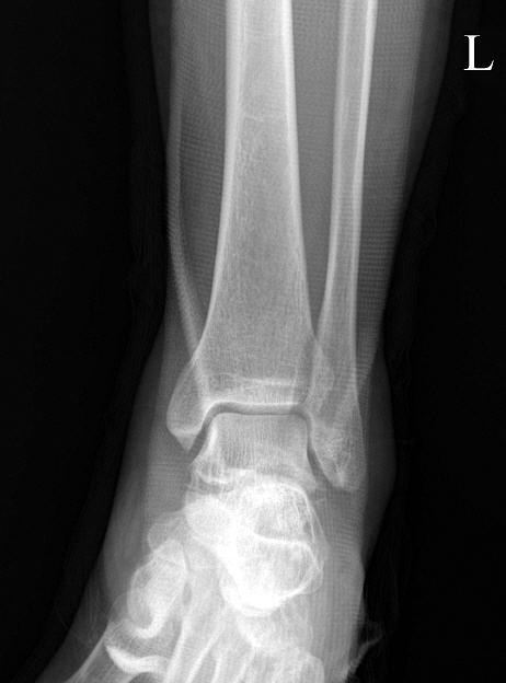 Peroneus Tendon Dislocation Associated with Fracture of Lateral Process of Talus 223 Fig. 1.