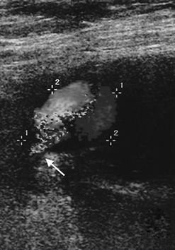 the other portion of the pseudoaneurysm. (B) A similar view showing the pseudoaneurysm neck (arrow) is demonstrated. 트롬빈 (thrombin) 직접주입요법이효과적이라고알려져있다.
