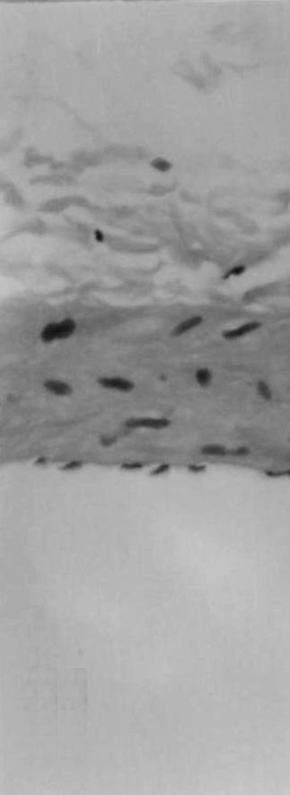 Arterial segment seeded with SMCs expressing HSVtk with