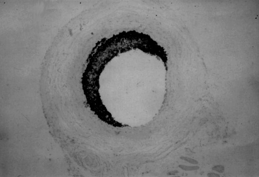 Histochemical staining for -galactosidase activity of the injured right rat carotid artery seeded with smooth muscle cells SMCs expressing -galactosidase. It was obtained 7 days after balloon injury.