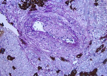 착상및태반발달과정에따른영양막세포의역할 대한생식의학회지 * * Figure 2. Remodeling of spiral artery in placental bed biopsy tissues between normal and pre-eclampsia.