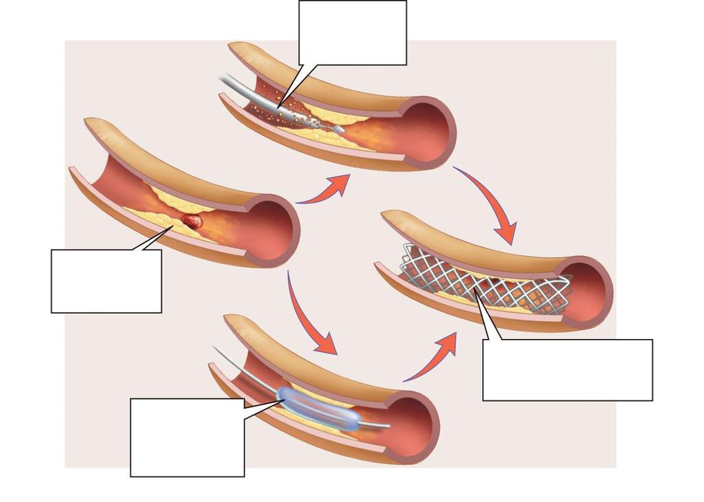 A tiny drill grinds away the plaque (c) or An artery is narrowed by plaque (a) A balloon is inflated,