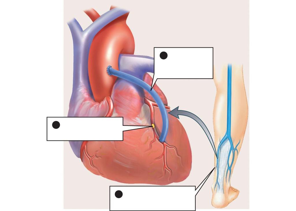 3 The grafted vein bypasses the obstruction 1 A coronary artery is blocked here