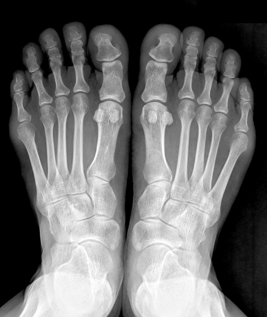 21 Sang Kil Kim, et al. Treatment of Bunionette Deformity Figure 2. A 52-year-old woman with painful plantar callosity under the 5th metatarsal head on the right side.