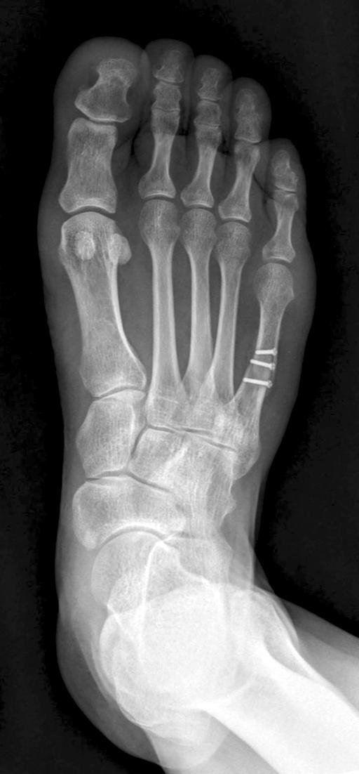 (B) The bunionette deformity was corrected with diaphyseal oblique osteotomy and fixed with three screws.