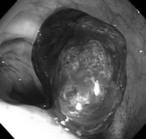 - 신재욱외 6 인 : 출혈을동반한용종형태의직장자궁내막증 1 예 - Figure 1. () ctive bleeding was seen from the entire surface of the 2 cm sized polyp on the rectum, 10 centimeters above the anal verge.