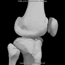 Patella Tibia, Fibula 3 joints: Patellofemoral Tibiofemoral Tibiofibular joint