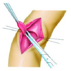 4) 수술방법 ( 가 ) 음경단축술 (Penile shortening procedure) Plication 혹은 wedge resection이대표적인술기이다.