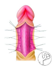 주된단점은전반적인음경길이의단축인데환자가이에예민하여잘받아들이지않지만, 실제로단축의정도는크지않고발기력에영향을주지않으며오히려음경체적의감소로발기력이향상되는장점도있으므로충분히설득한다면좋은결과를얻을수있다. 시행방법은그림 1과같다.