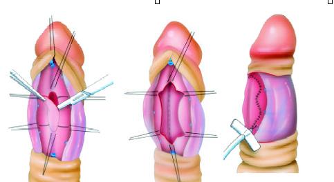 ( 나 ) 백막절개혹은제거후이식술 (Excision or incision of tunica and grafting) 이방법은병변을제거하거나절개하여벌린후에결손을여러조직편을이용하여메꾸는방법 ( 그림 2) 으로길이가짧아지지않는것이최대의장점이다.