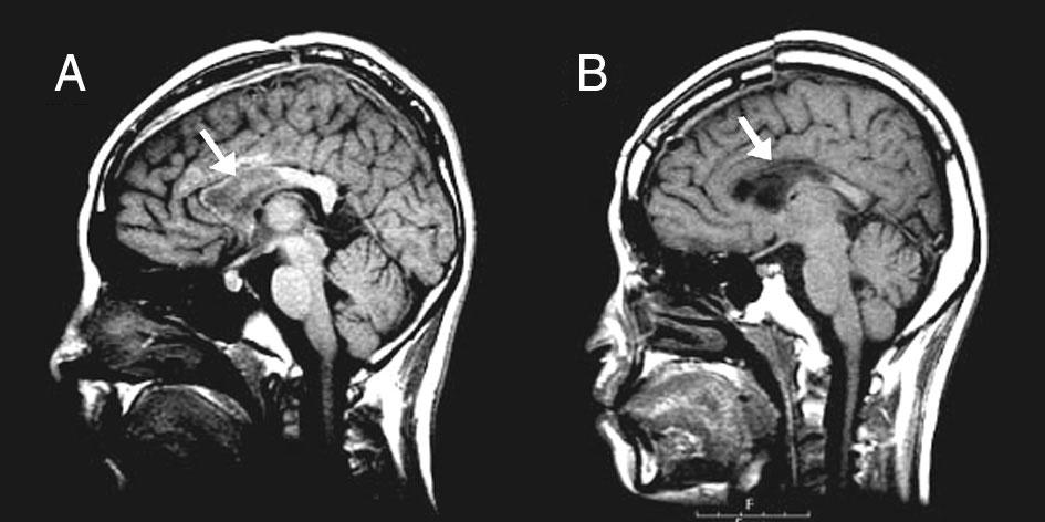 Corpus callosotomy. Thirteen year old girl (A) and 15 year old body (B) have suffered from frequent atonic seizures.