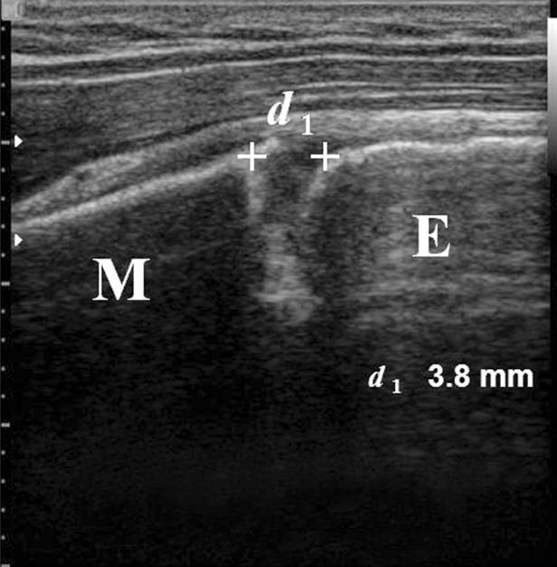 (A) Three-dimensional computed tomography of shoulder shows anatomical relationship between anterolateral corner of acromion (arrow) and proximal humeral epiphysis (dotted box