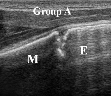 (A) Only physeal irregularity with minimal increased gap (<1 mm).