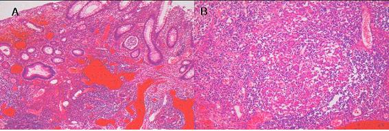 Lymphoid hyperplasia and multiple non-caseating granulomas are shown. PCO 2 29.5 mmhg, PO 2 75.0 mmhg, HCO 3 24.8 mmol/l, 일반화학검사에서 BUN/Cr 63/2.0 mg/dl, AST/ALT 126/98 U/L, Na/K/Cl 135/4.