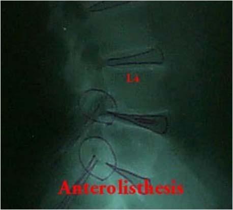 3) Anterolisthesis 가 ) 척추의추체가전방으로 translation 이일어나는것을 말한다.