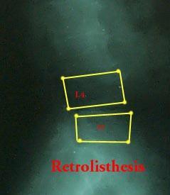 요추분석 Retrolisthesis 일반적으로척추의추체가후방으로