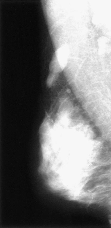 대한초음파의학회지 제24권 제3호 2005 유방의 일차성 림프종(primary breast lymphoma)은 유방의 악성 종양의 0.12 %-0.53%를 차지하는 비교적 드문 종양이 다 [4, 5].