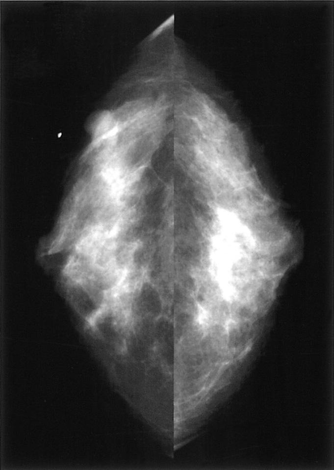 Primary breast lymphoma in a 42-year-old woman presented with a palpable mass in right breast for 1 year.