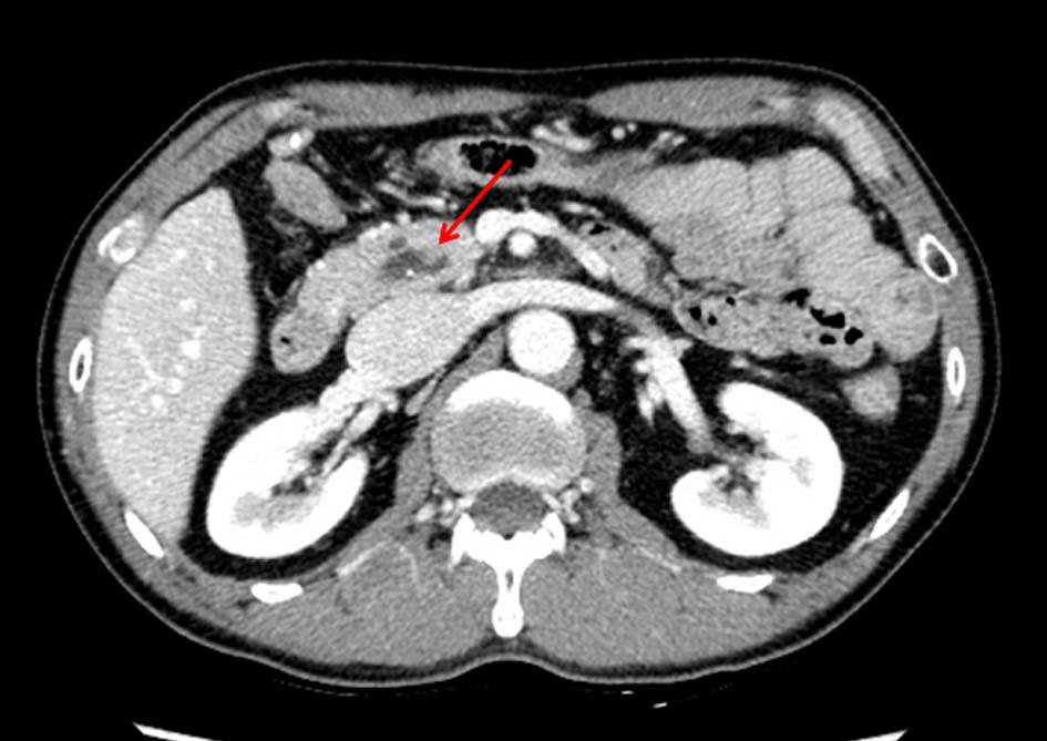 (A) MRCP shows Todani type 1 choledochal cyst (a gallbladder collapses).
