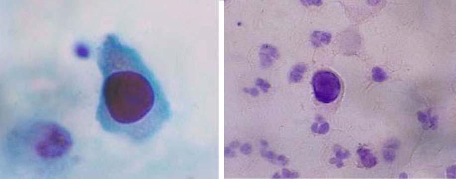 홍은경 : 요로종양의세포병리 11 Fig. 7. Decoy cells in voided urine. The cells show very large hyperchromatic nucleus in the center.