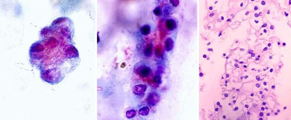 홍은경 : 요로종양의세포병리 15 C Fig. 11. Renal cell carcinoma in voided urine.