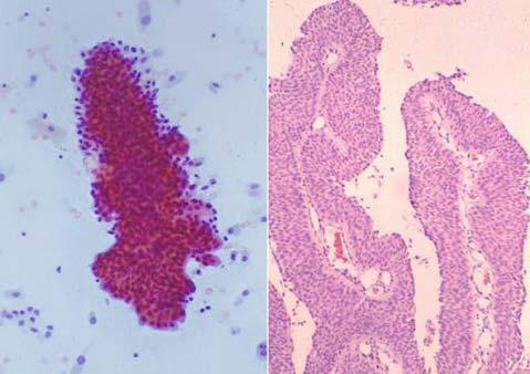 (C, D) The clustered epithelial cells show irregular nuclear border, slightly enlarged nuclei and cytoplasmic homogeneity. Fig. 2. Low grade papillary urothelial carcinoma in catheterized urine.