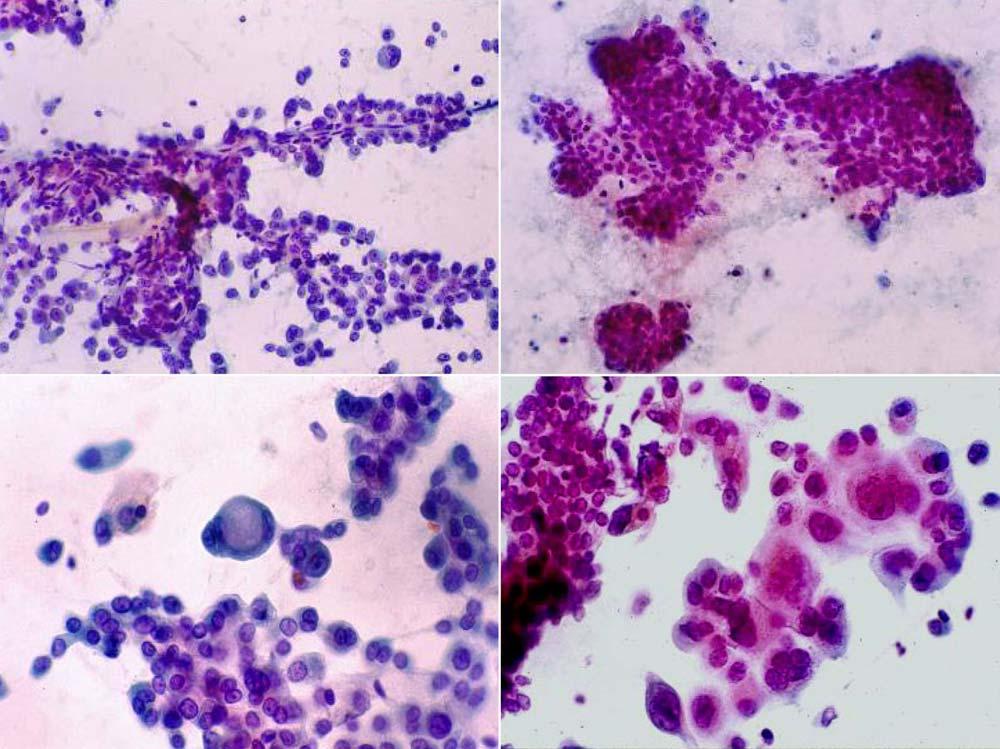 6 대한세포병리학회지 / 제 17 권 / 제 1 호 / 2006 C D Fig. 3. High grade urothelial carcinoma in catherized urine. The cellularity is high with many variable sized cell clusters and singly scattered cells.